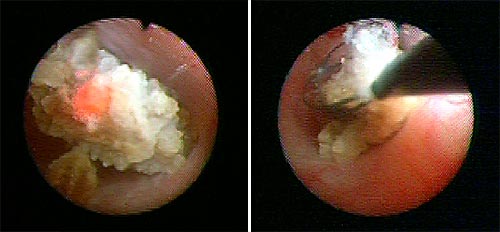 Flexible-Ureterorenoskopie-RIRS-Harnsteinzentrum-Muenchen